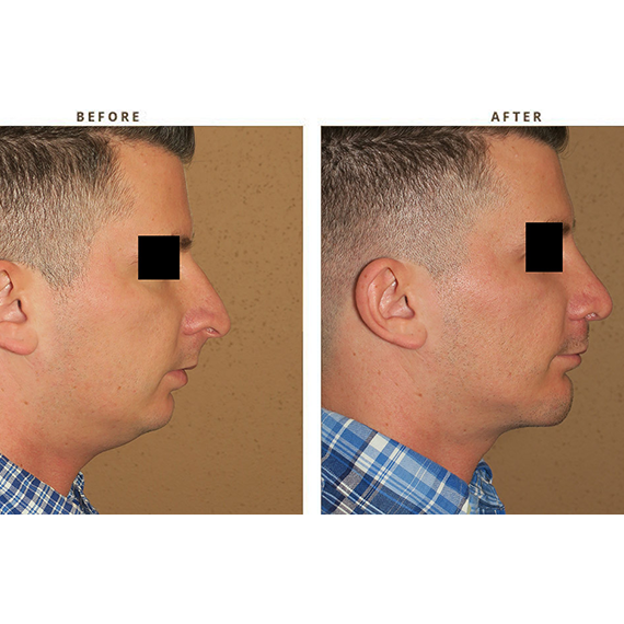 Bra Fat Be Gone: Destroy Excess Fat With Kybella: Rostami OPC: Oculofacial  Plastic Surgeons