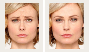Annie-botox-bna-edited