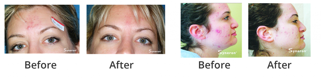 acne_2_02