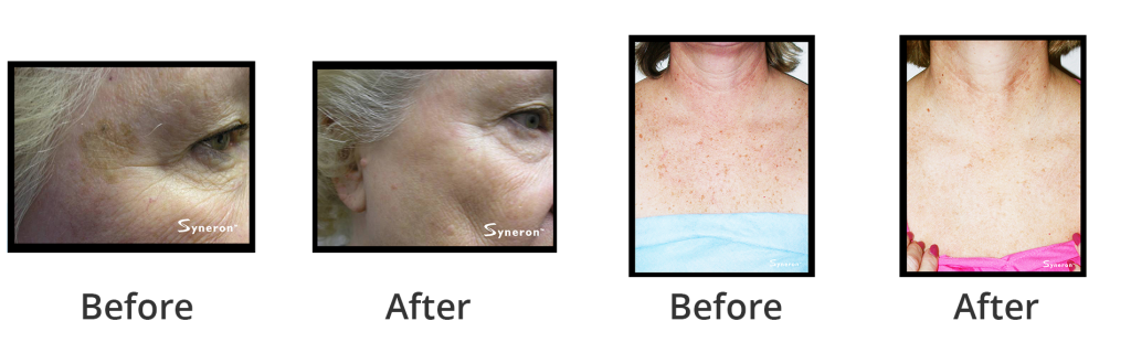 facial1