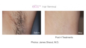elos hair removal 2