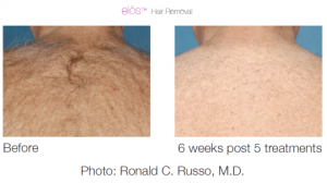 elos hair removal 3