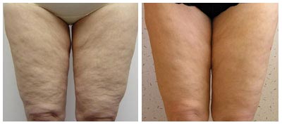 MesotherapyPhotos