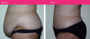 ~Public~Newbie Media~ACTIVE~MOOREA~Before After Images~Dr. Beber - Body Contouring~abdominoplasty female 2