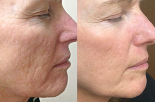 IMGATTACH_636_1438870022_Rejuvapen_Micro_Fractional_Collagen_Pittsburgh_Cheeks_1